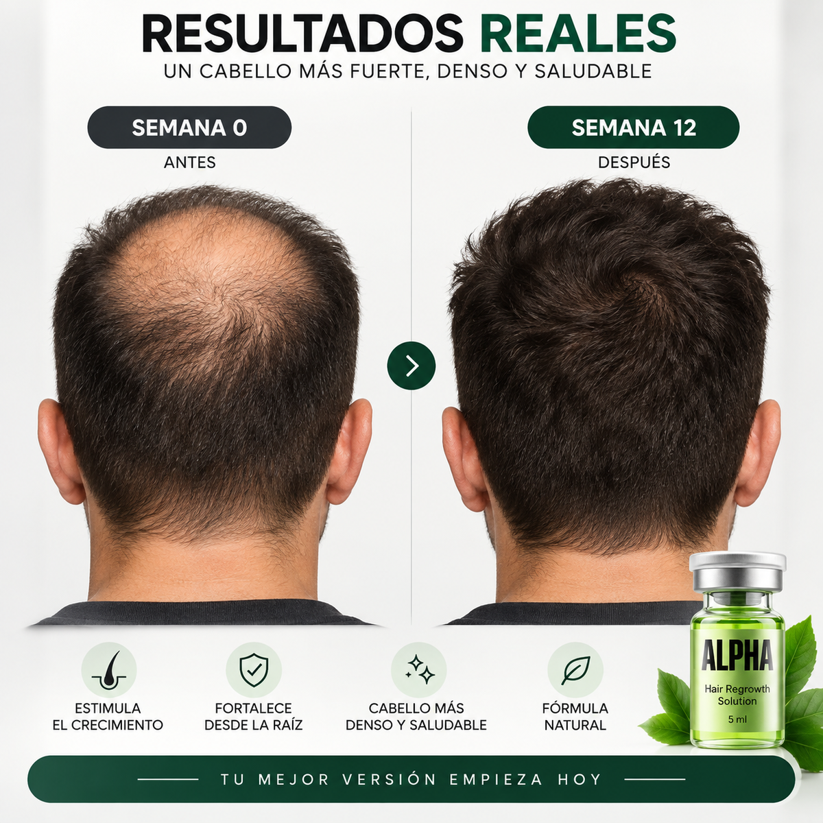 Alpha™ – Sistema de Regeneración Capilar